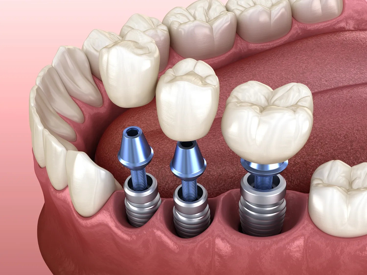 Kiedy po wyrwaniu zęba można wstawić implant?